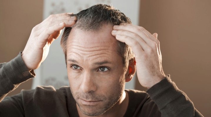 Tout sur les cheveux rares chez les hommes